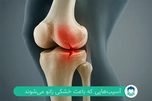 بیماری‌هایی که باعث خشکی زانو می‌شوند | ایران طب مگ