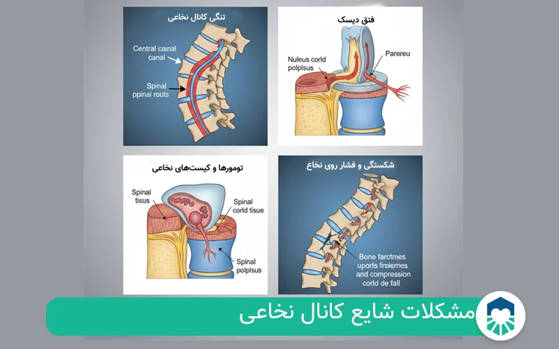 مشکلات شایع کانال نخاعی | ایران طب مگ