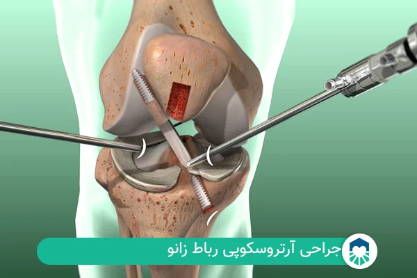 جراحی رباط زانو | ایران طب مگ