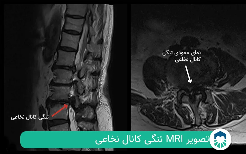 mri تنگی کانال نخاعی | ایران طب مگ