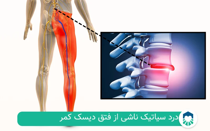 درد سیاتیک ناشی از دیسک کمر | ایران طب مگ