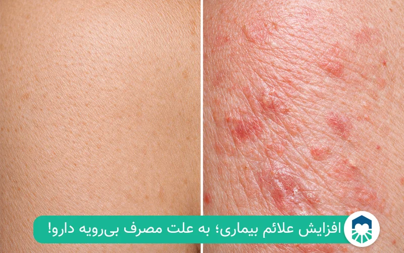 عوارض جانبی بتامتازون | ایران طب مگ